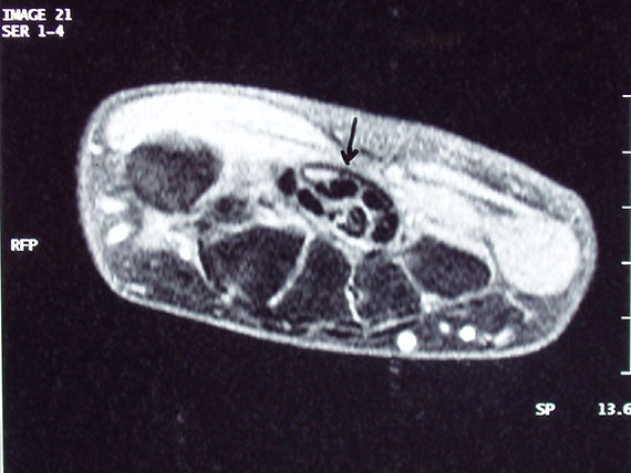 Röntgenový snímok karpálneho tunela